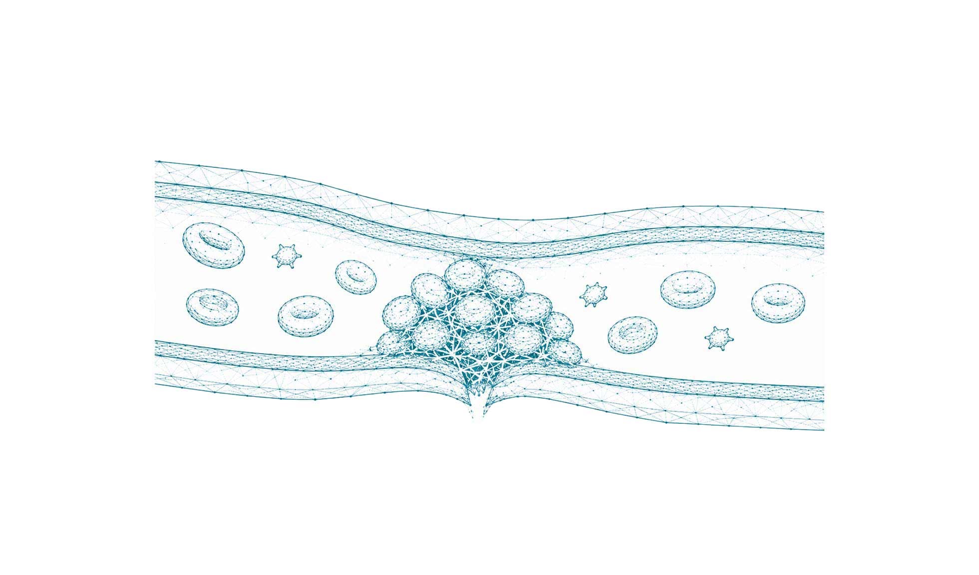 Blutgefäß mit Thrombus aus Blutplättchen und Fibrinnetz
